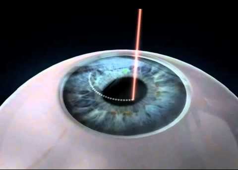 Corrective Eye Surgery